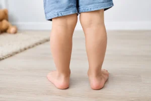 Befelé forduló lábfej gyermeknél - mikor gond?